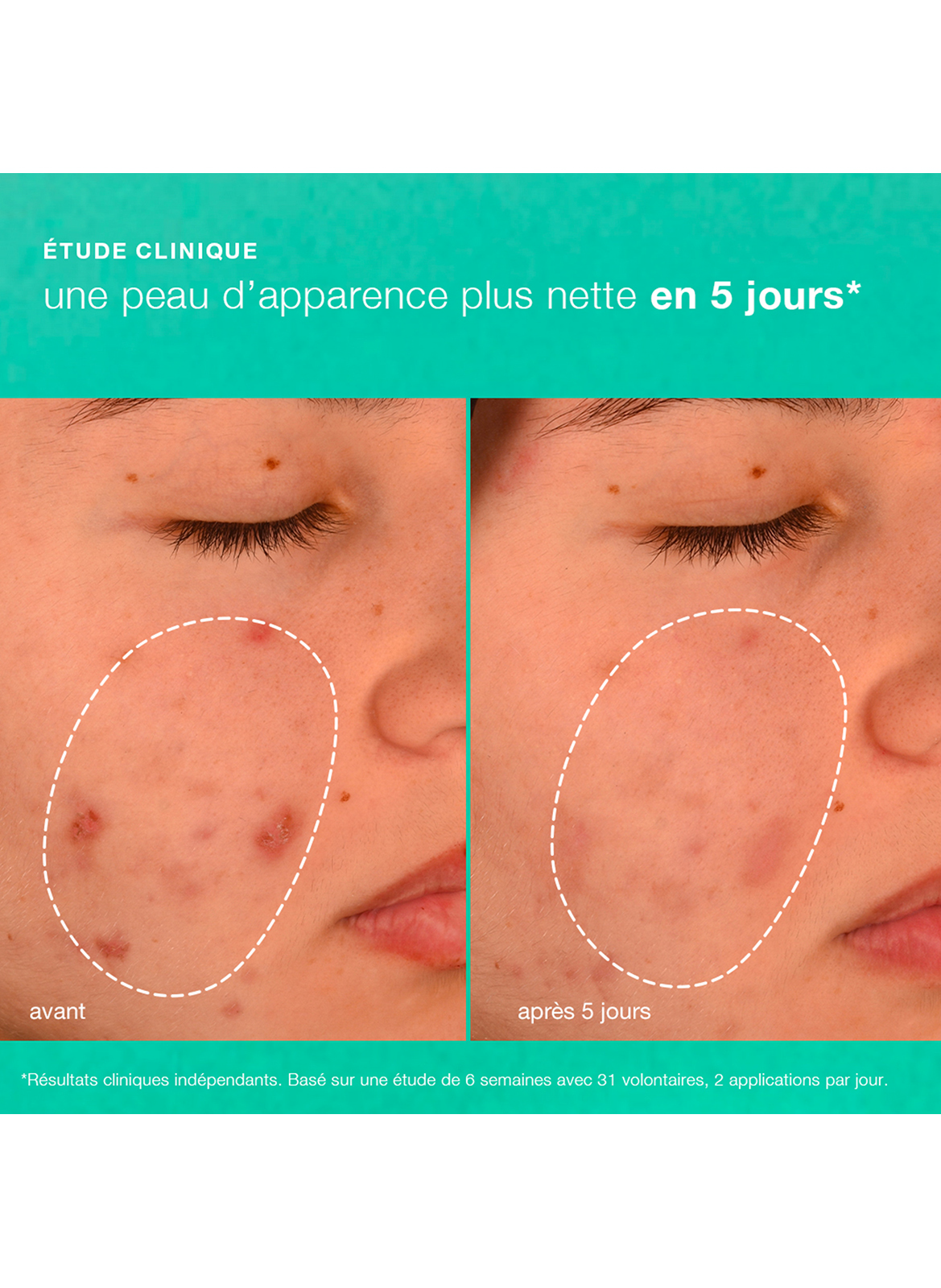 Breakout biotic moisturizer DERMALOGICA No color