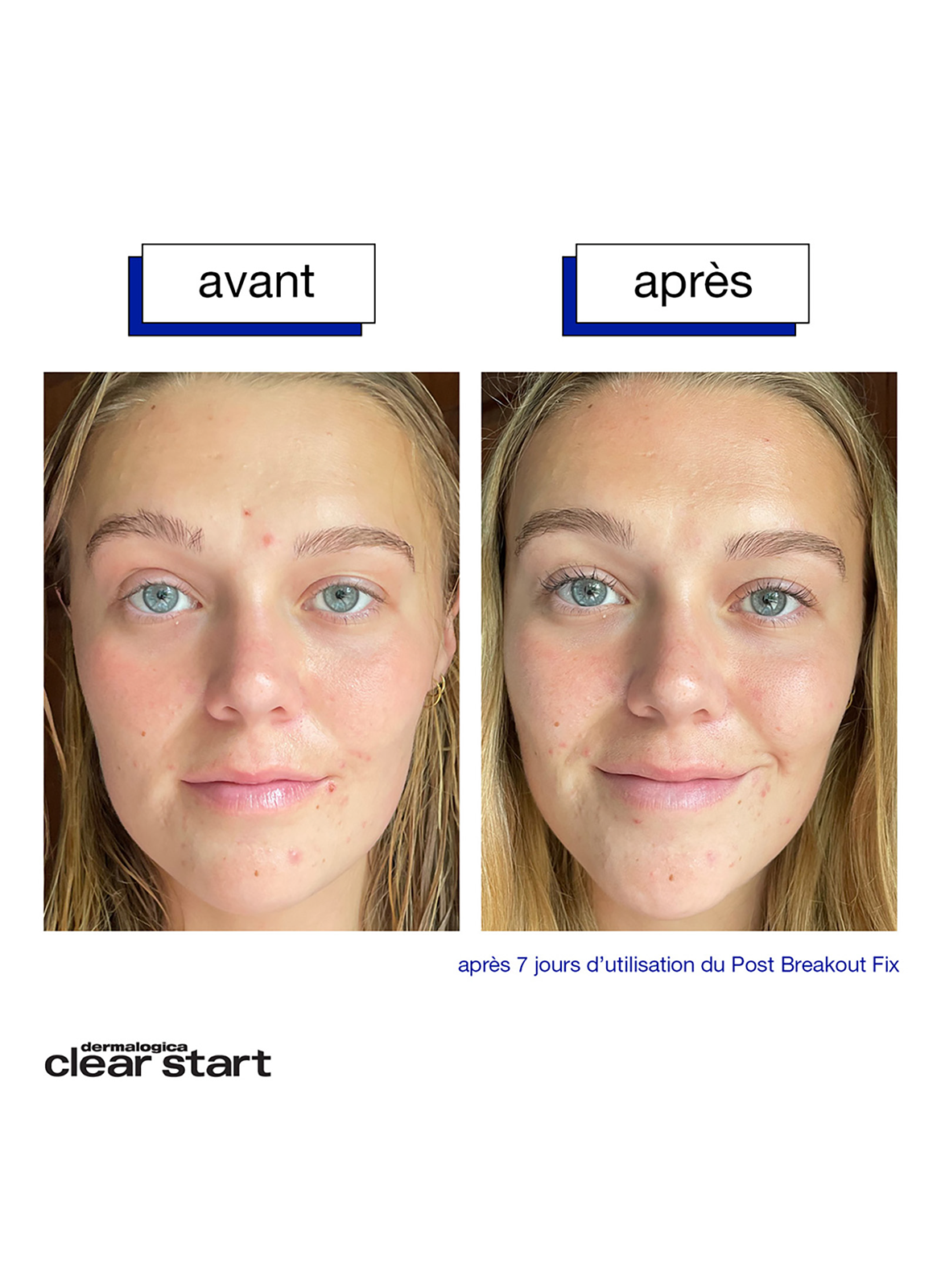 Post-Breakout Fix DERMALOGICA No color