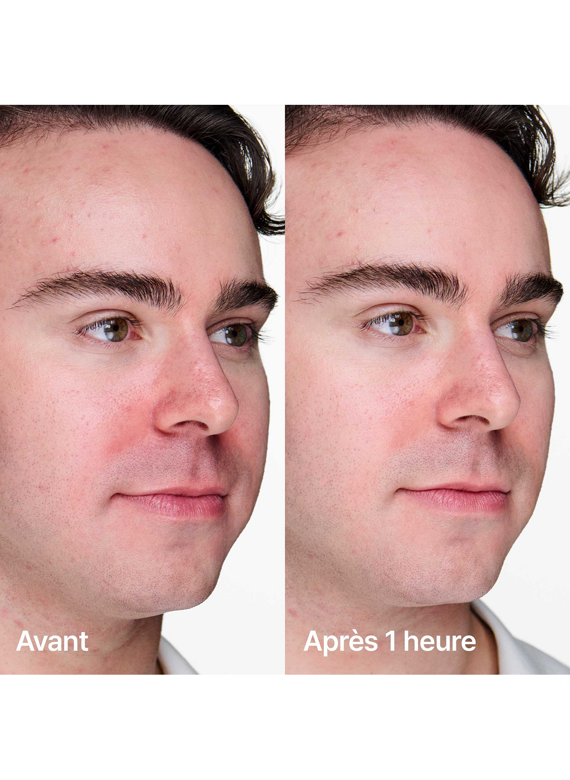 Anti-Blemish Solutions™ - Gel Anti-imperfections + CLINIQUE No color